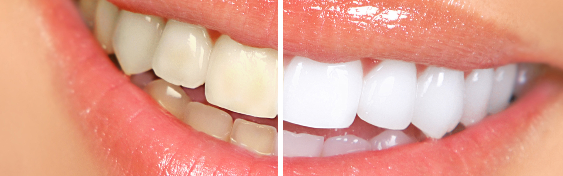 Teeth Whitening