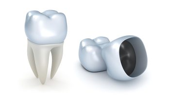 How Can I Get Rid of Plaque on Dental Crowns? How Can I Get Rid of Plaque on Dental Crowns?
